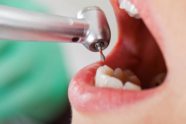 Best Emergency Root Canal Treatment in Stony Point, MI